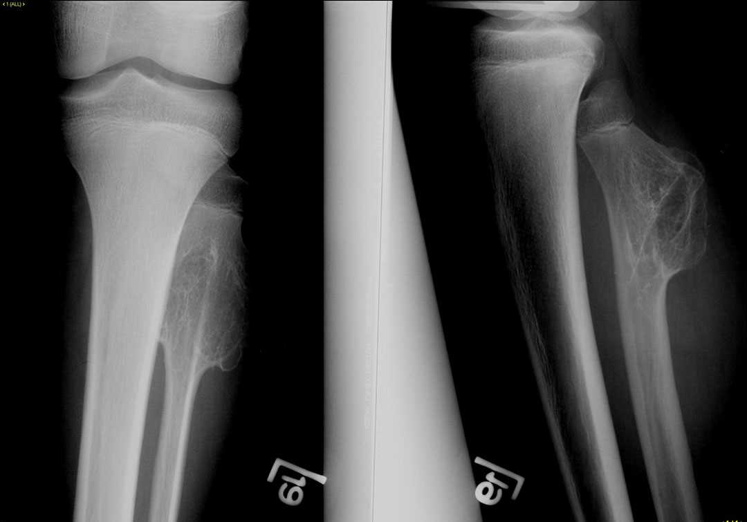Osteochondroma of the fibula - X Rays Case Studies - CTisus CT Scanning