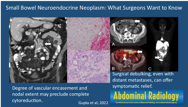 Small Bowel Neuroendocrine Neoplasm What Surgeons Want To Know