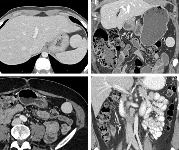 Accessory Spleen CT Findings