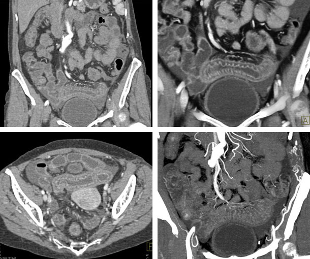 ACE Inhibitor-Induced Angioedema CT Findings