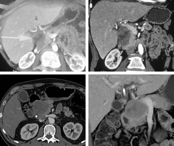 Acinar Tumor CT Findings
