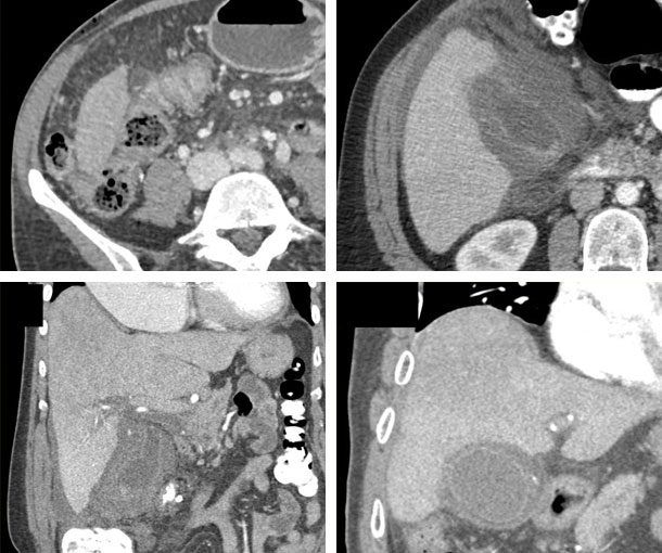 Acute Cholecystitis CT Findings