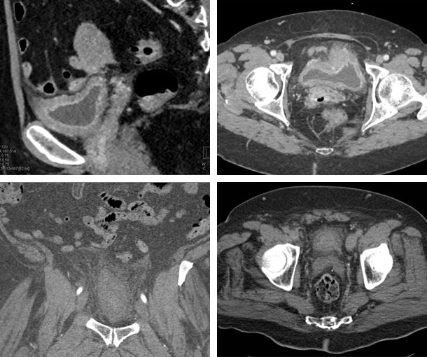 Acute Cystitis CT Findings
