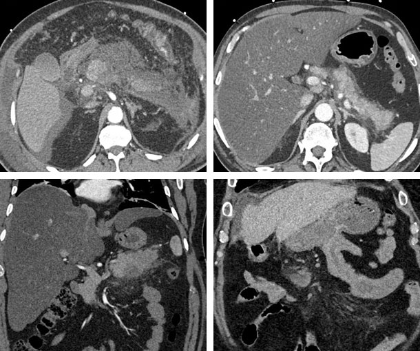 Acute Pancreatitis CT Findings