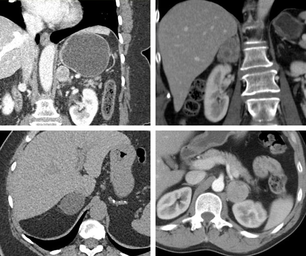 Adrenal Adenoma