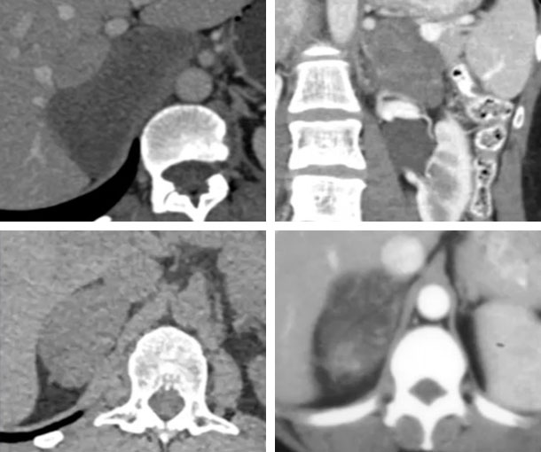 Adrenal Ganglioneuroma