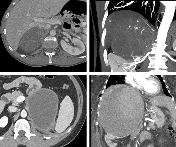 Adrenal Hematoma CT Findings