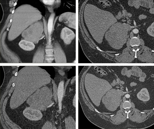 Adrenal Leiomyosarcoma CT Findings