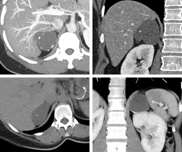 Adrenal Lymphangioma CT Findings