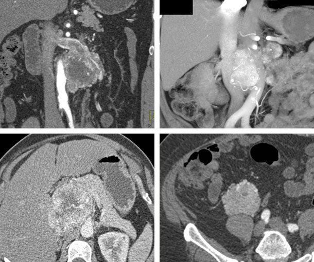 Adrenal Paraganglioma