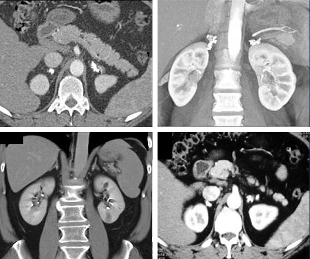 Adrenal Tuberculosis CT Findings