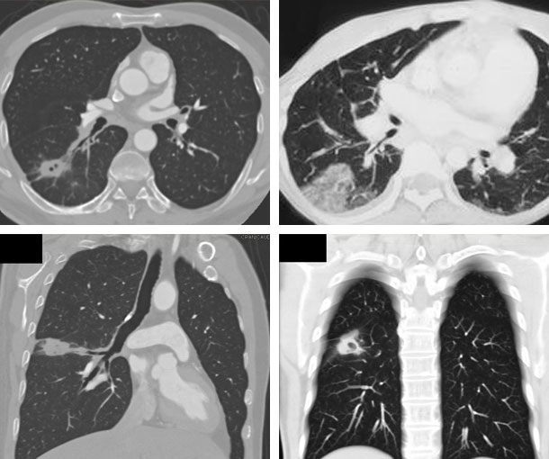 Adenocarcinoma In Situ (AIS) CT Findings
