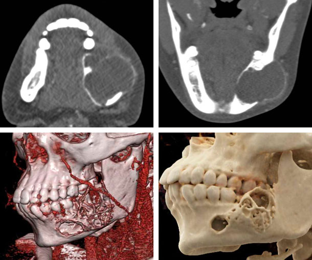 Ameloblastoma