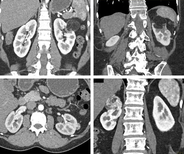 Angiomyolipoma (AML) CT Findings