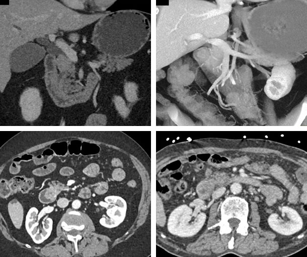 Ampullary Carcinoma CT Findings