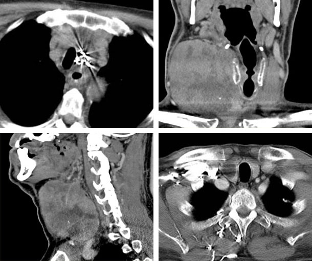 Anaplastic Thyroid Carcinoma CT Findings