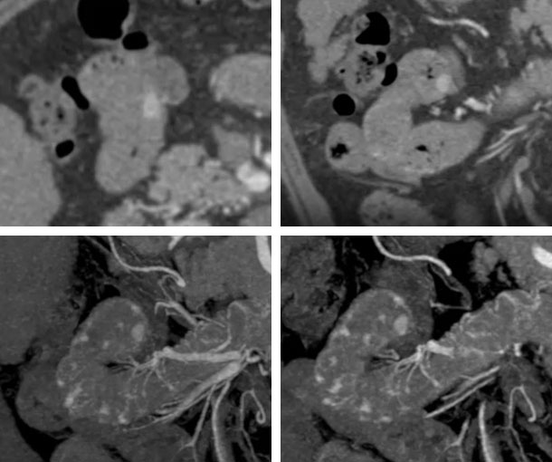 Small Bowel Angiodysplasia CT Findings