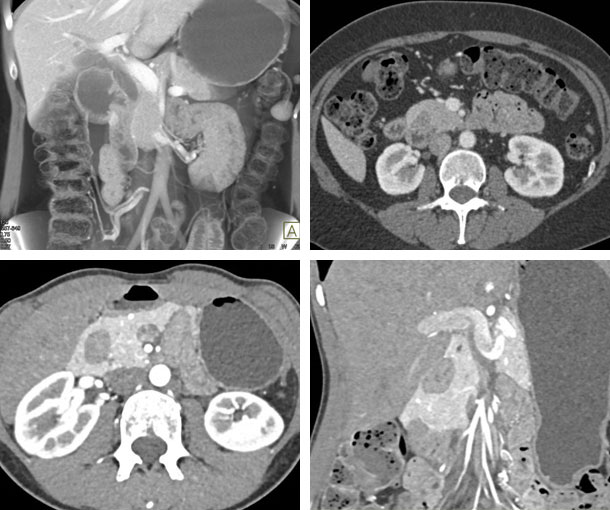 Annular Pancreas CT Findings