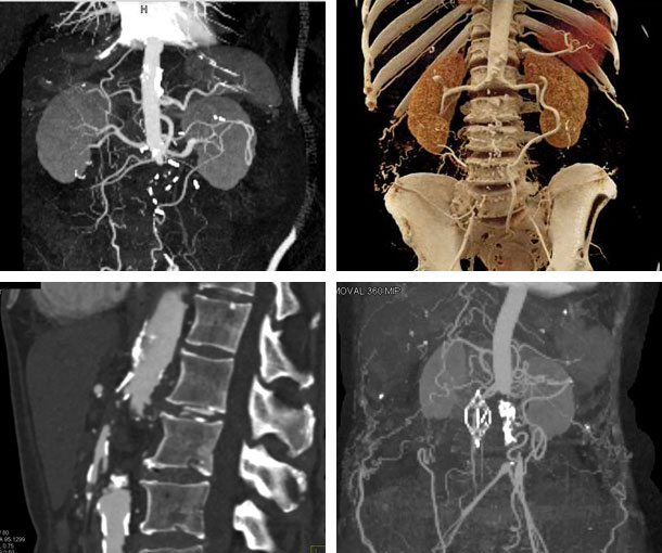 Aortic Occlusion CT Findings