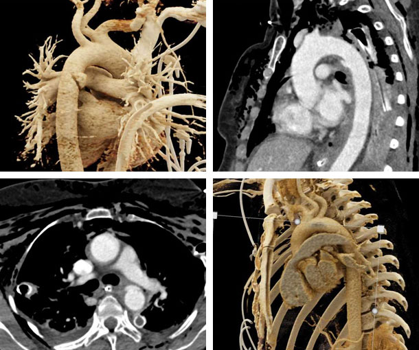 Aortic Transection CT Findings