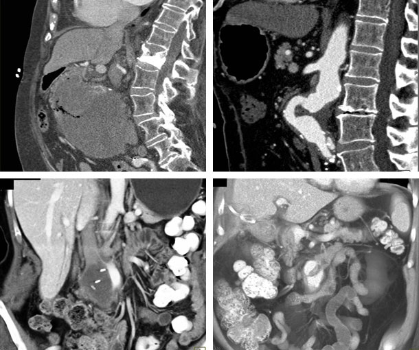 Aortoenteric Fistula CT Findings