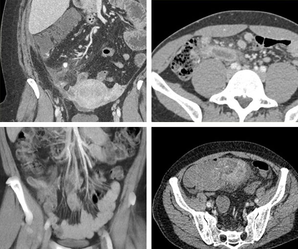 Appendicitis CT Findings