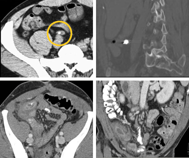 Appendicolith CT Appearance