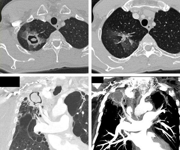 Aspergilloma CT Findings