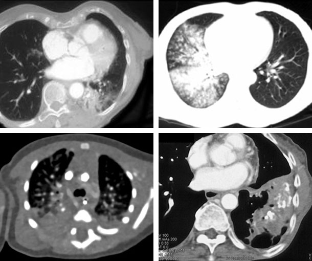 Aspiration Pneumonia CT Findings