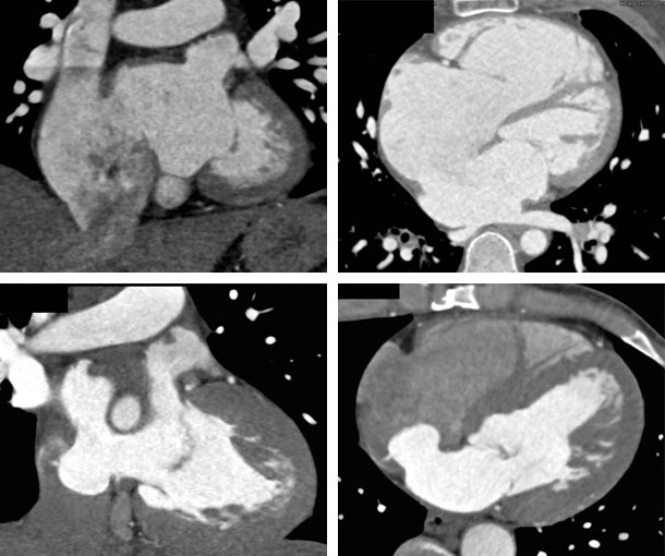Atrial Septal Defect (ASD) CT Findings