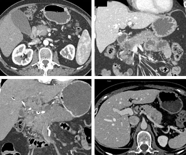 Autoimmune Pancreatitis CT Findings