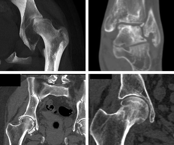 Avascular Necrosis (AVN)