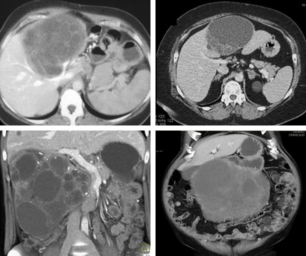 Biliary Cystadenocarcinoma CT Findings