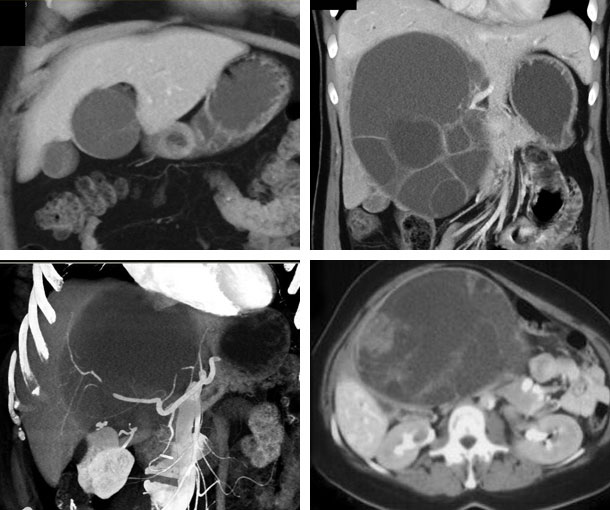 Biliary Cystadenoma CT Findings