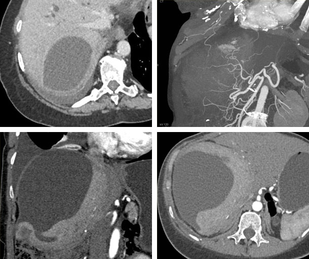 Biloma CT Findings