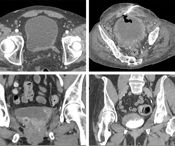 Bladder Cancer CT Findings