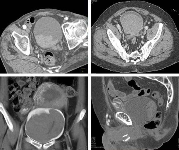 Bladder Hematoma CT Findings