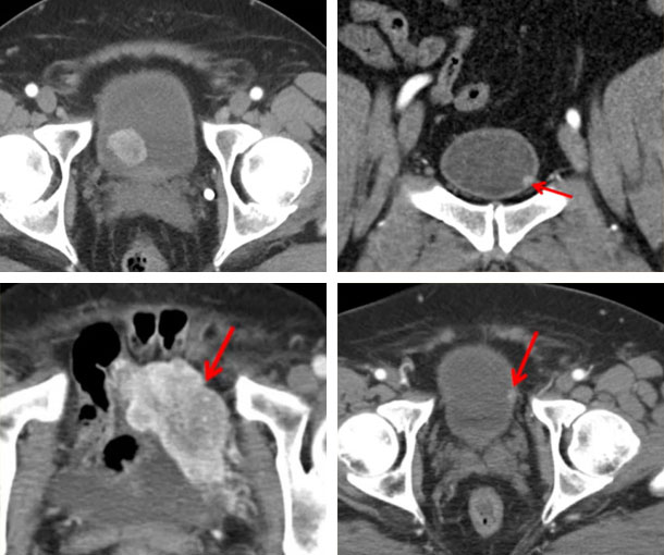 Bladder Paraganglioma CT Findings