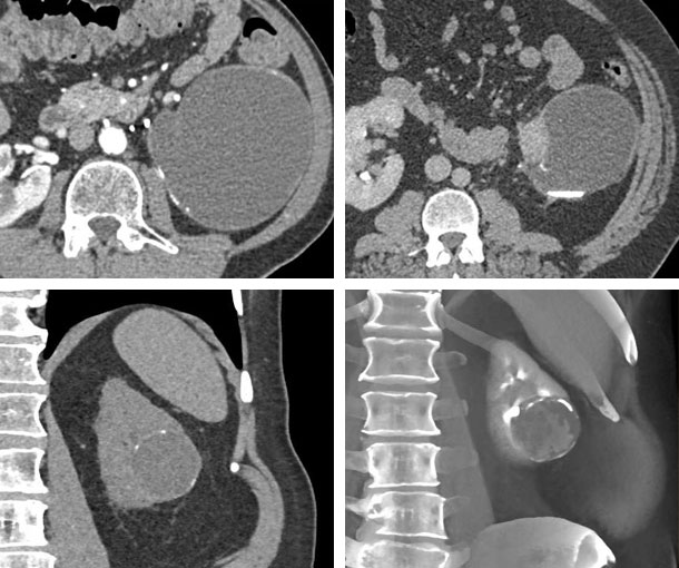 Bosniak 2 Cyst CT Findings