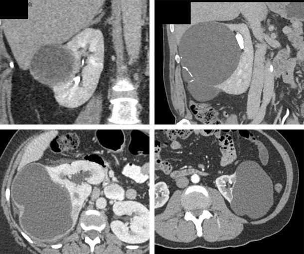 Bosniak 2F Cyst CT Findings