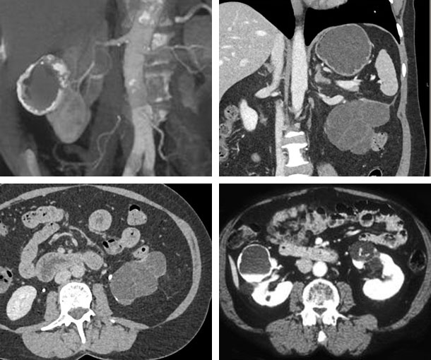Bosniak 3 Cyst CT Appearance
