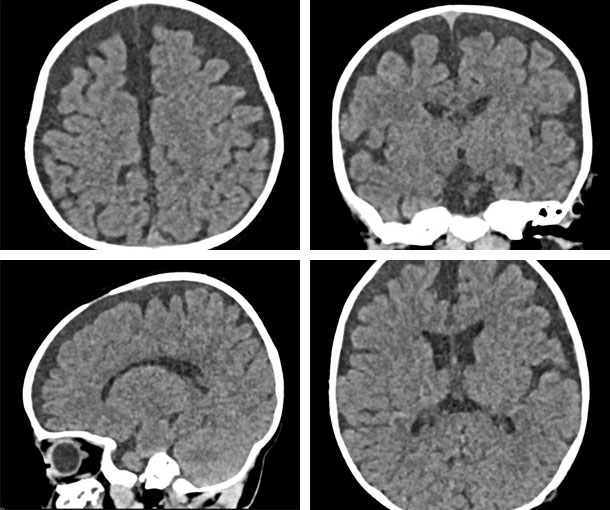 Brain Atrophy CT Findings