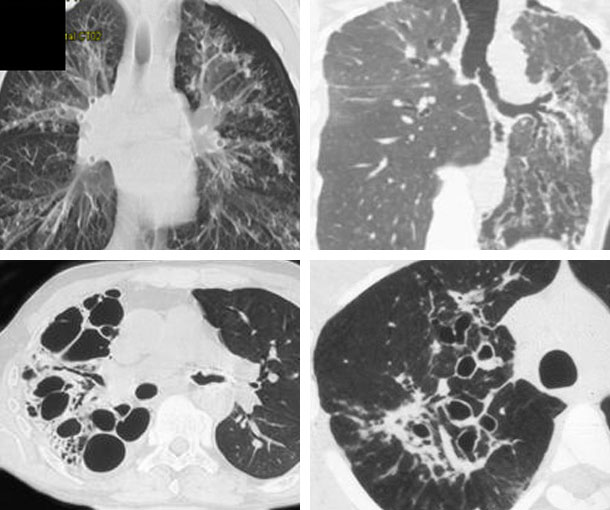 Bronchiectasis CT Findings