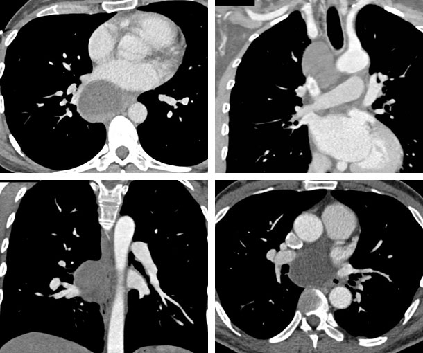 Bronchogenic Cyst CT Findings