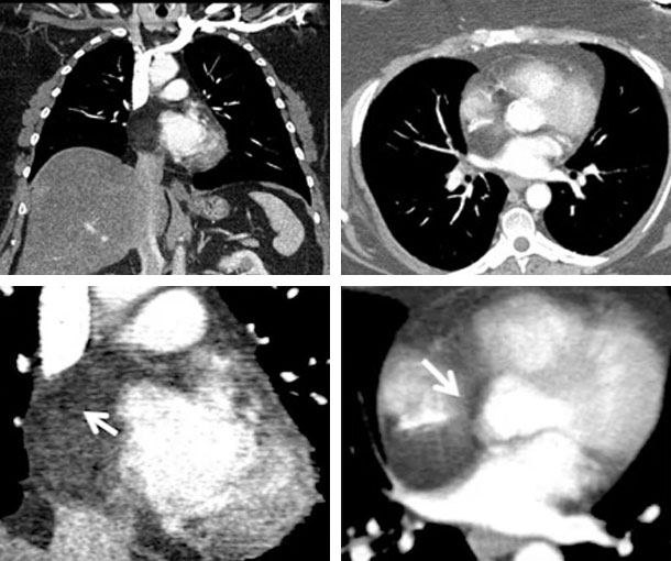 Cardiac Lipoma CT Findings