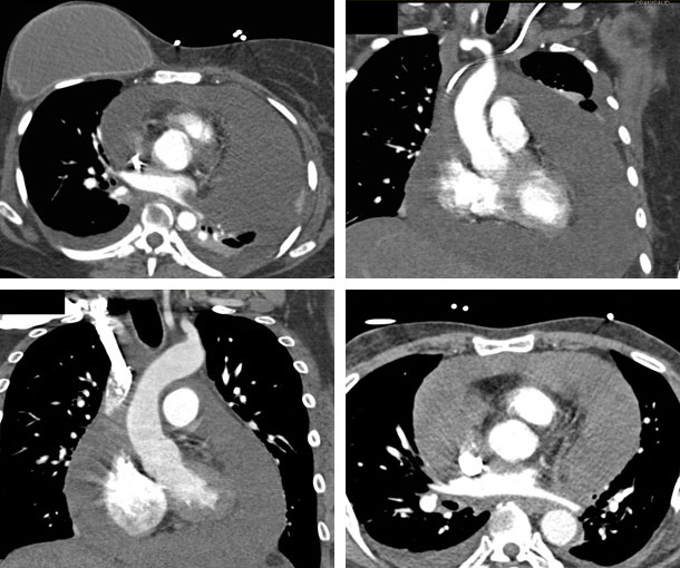 Cardiac Tamponade CT Findings