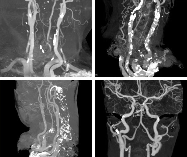 Carotid Artery Disease CT Findings