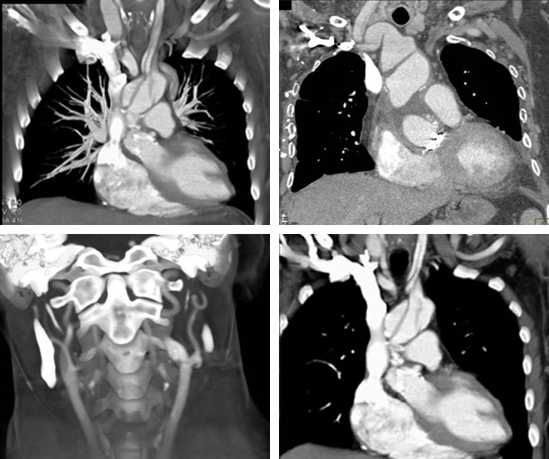 Carotid Artery Dissection CT Findings