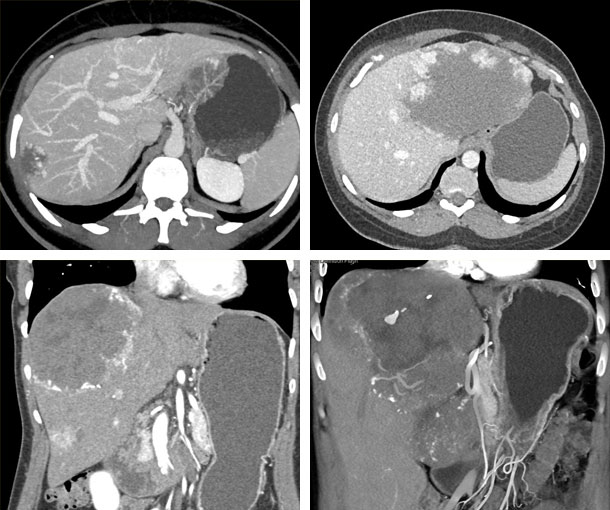 Cavernous Hemangioma CT Findings