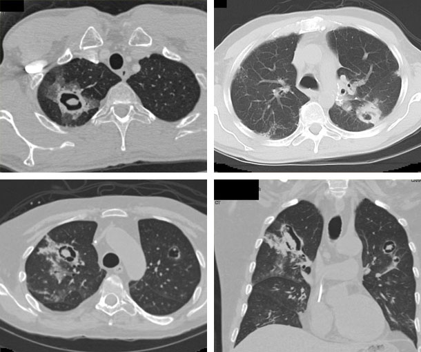 Cavitary Lesion CT Findings